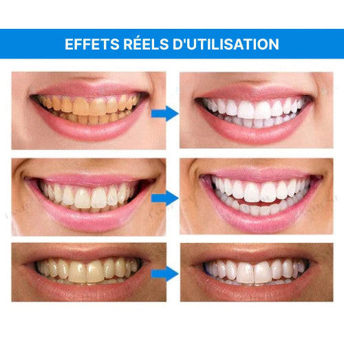 STYLO DE BLANCHIMENT DES DENTS