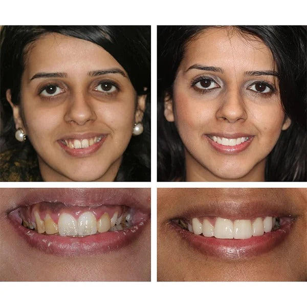 STYLO DE BLANCHIMENT DES DENTS