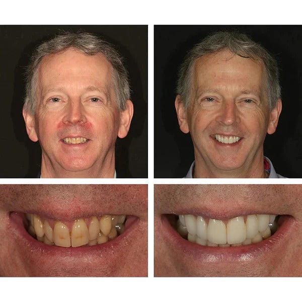 STYLO DE BLANCHIMENT DES DENTS