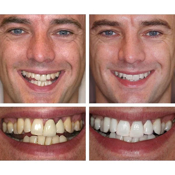 STYLO DE BLANCHIMENT DES DENTS